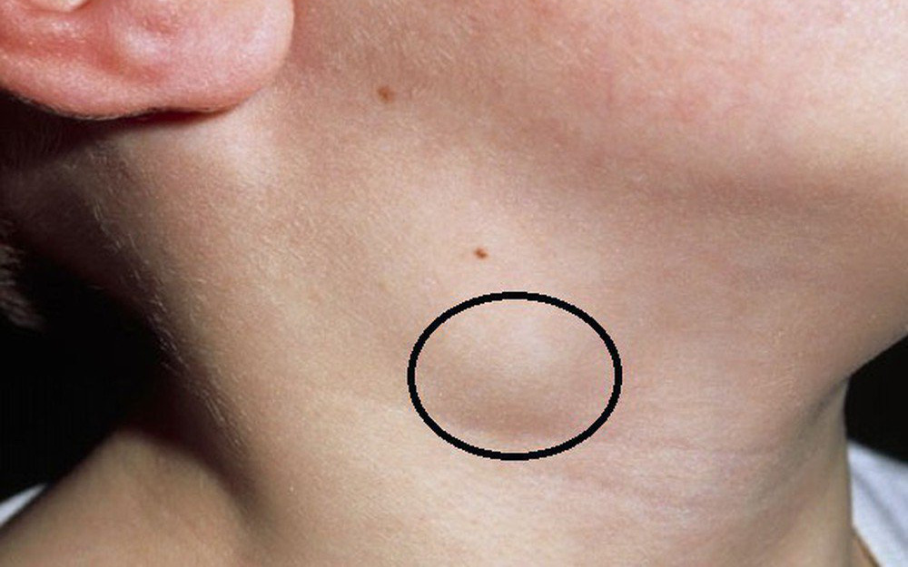 Rubella bị sưng hạch: Sưng hạch do bệnh Rubella có nguy hiểm không?