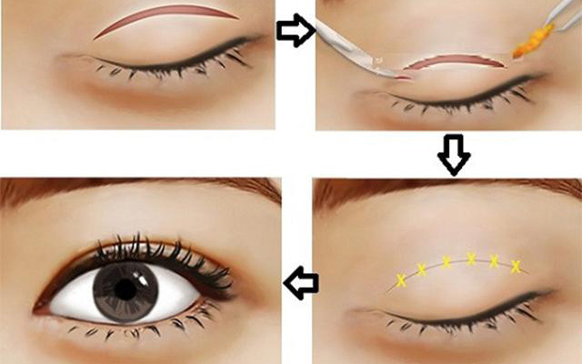 Cắt mí mắt: Hậu quả khôn lường và biện pháp khắc phục mí mắt bị lỗi, hỏng