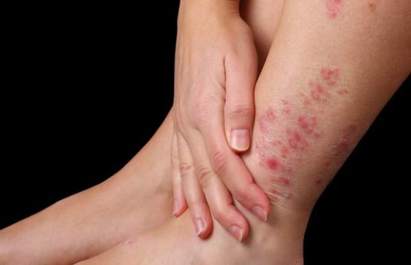 Tìm hiểu 10 bệnh ngứa ngoài da vào mùa hè thường gặp - Ảnh 4.