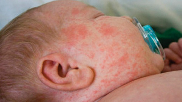 Trẻ bị sốt rubella cần làm gì? Dấu hiệu và cách xử lý - Ảnh 1.