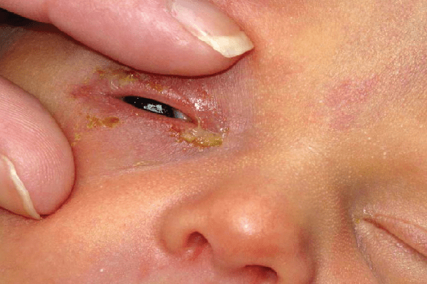 Những bệnh đau mắt ở trẻ sơ sinh phổ biến - Ảnh 1.
