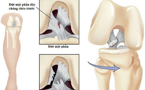 Những điều cần biết về đứt dây chằng chéo trước để xử lý sớm tránh biến chứng nguy hiểm