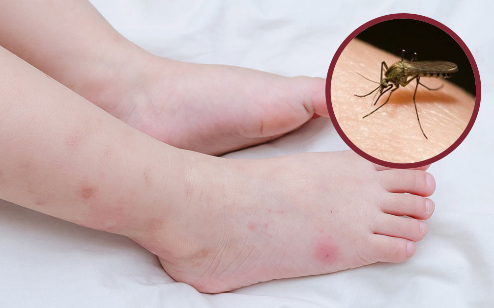 Làm thế nào để ngăn ngừa khi bị muỗi đốt thường xuyên?