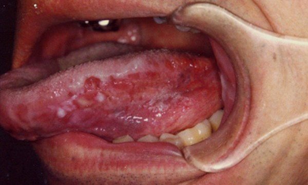 Ung thư lưỡi là gì? Tổng quan về căn bệnh ung thư lưỡi - Ảnh 2.