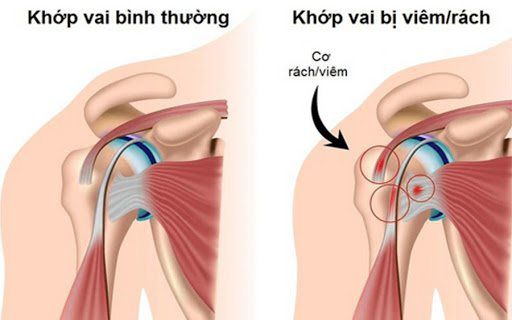 Viêm quanh khớp vai là gì? Những thông tin cần biết về viêm quanh khớp vai