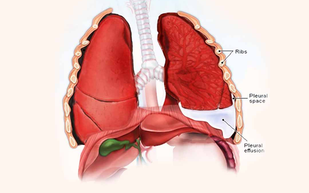 Nguyên nhân, triệu chứng và cách điều trị tràn dịch màng phổi