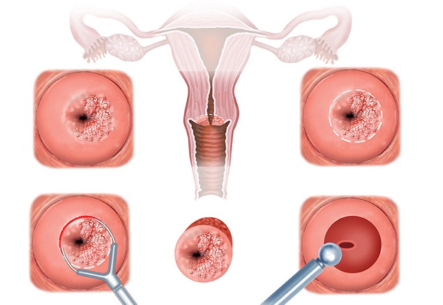 Viêm lộ tuyến cổ tử cung là gì? Nguyên nhân, triệu chứng và cách điều trị bệnh - Ảnh 1.