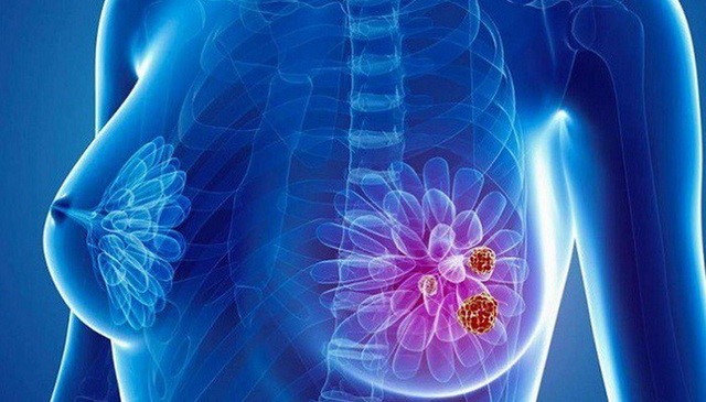 Ung thư vú: Dấu hiệu nhận biết và biện pháp phòng ngừa - Ảnh 6.