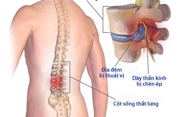 Thoái hoá đốt sống lưng nên ăn gì để mau khỏi bệnh?