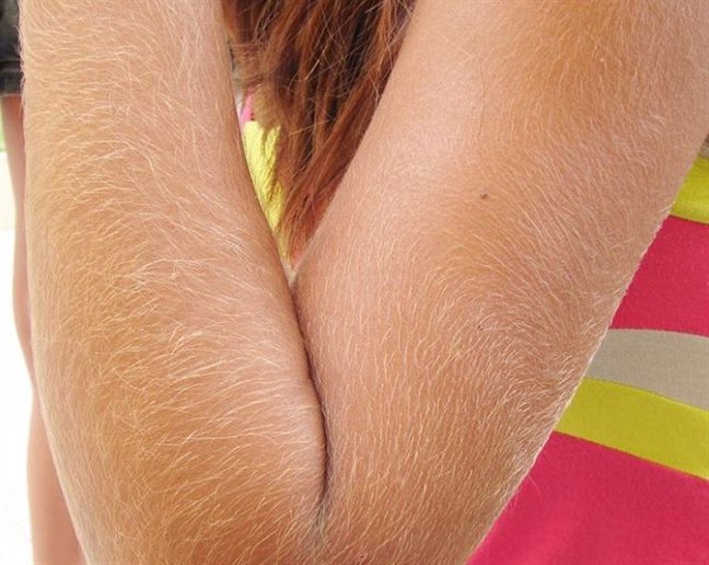 Tình trạng rậm lông ở phụ nữ: Nguyên nhân và biện pháp khắc phục - Ảnh 2.