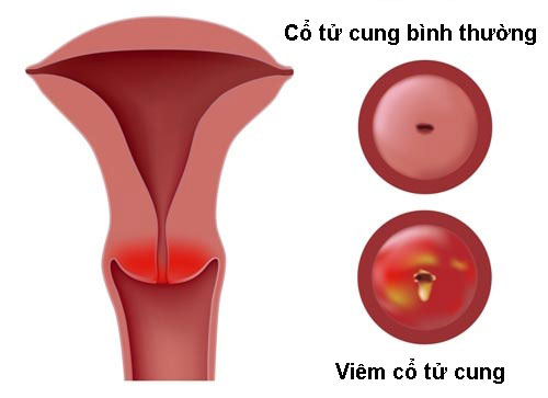 Viêm cổ tử cung: Nguyên nhân, triệu chứng và cách điều trị bệnh - Ảnh 1.