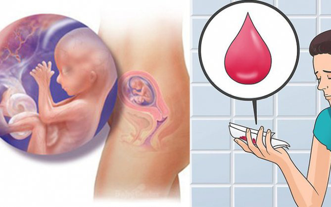 Tại sao máu sảy thai có thể xuất hiện đột ngột?
