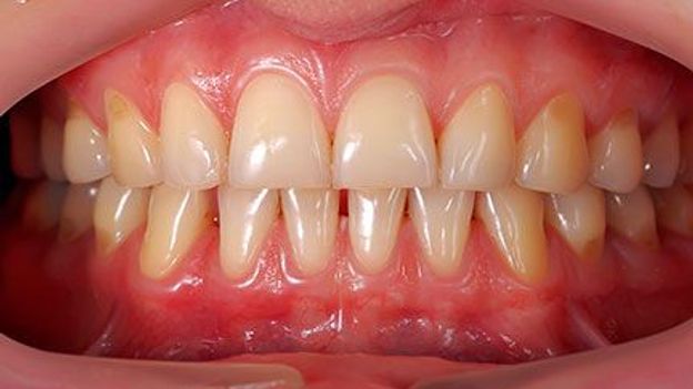 Tụt nướu răng là gì? Gợi ý cách trị tụt nướu răng tại nhà hiệu quả - Ảnh 2.