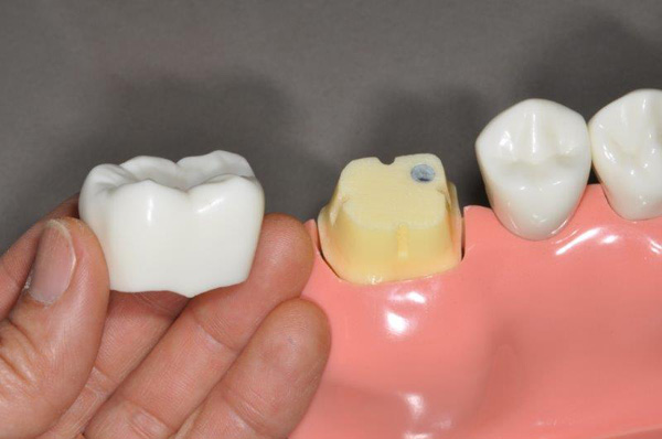 Tìm hiểu răng đã lấy tủy tồn tại được bao lâu? - Ảnh 2.