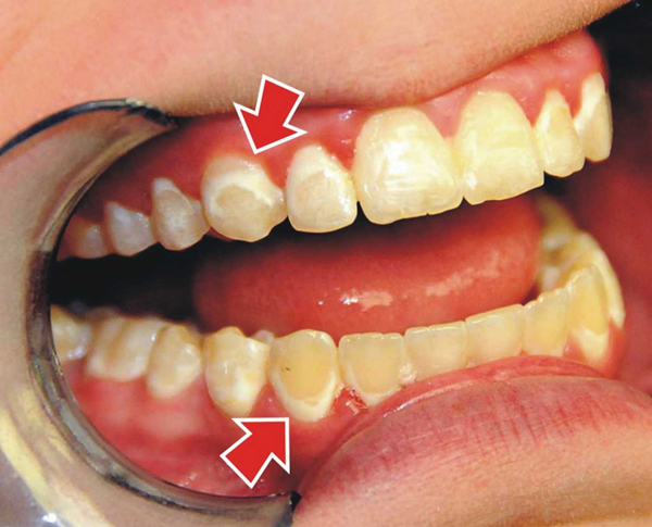 Điểm danh các bệnh về răng miệng phổ biến và cách phòng ngừa - Ảnh 2.