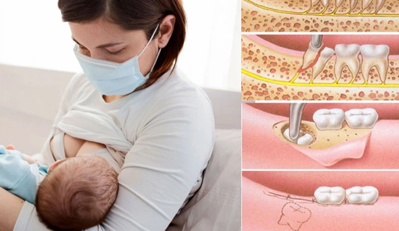 Đang cho con bú có nhổ răng được không? Cần lưu ý gì nếu bắt buộc nhổ răng khi cho con bú? - DNTT online