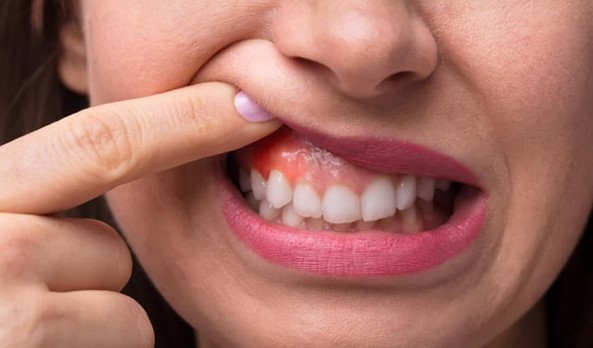 Phẫu thuật cắt chóp răng là gì? Cắt chóp răng có nguy hiểm không và bao lâu thì lành? - Ảnh 2.