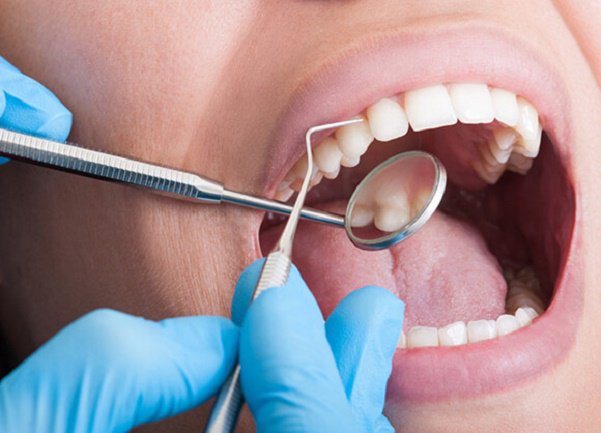 Sau khi lấy cao răng nên kiêng gì? Cần lưu ý gì sau khi lấy cao răng? - Ảnh 2.