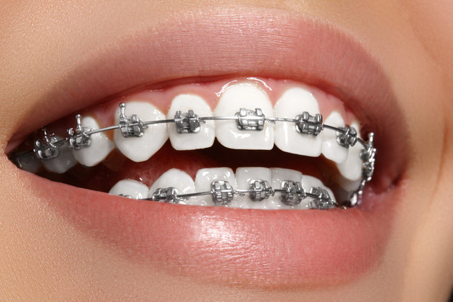 Giải thích nguyên nhân niềng răng bị hóp má và cách khắc phục - Ảnh 4.