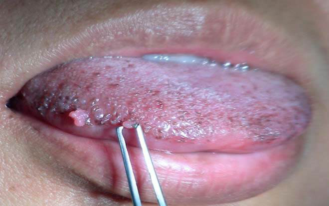 Thông tin từ A đến Z về bệnh sùi mào gà ở lưỡi