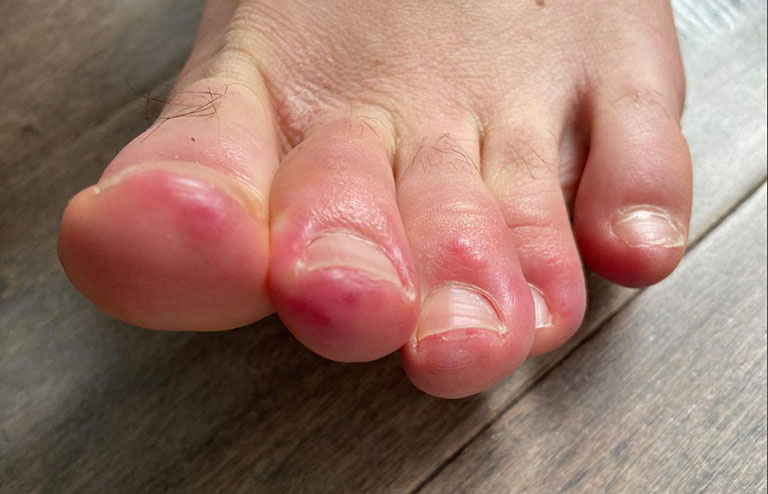 Ngón chân cái bị sưng đau mưng mủ do đâu? Cần làm gì? - Ảnh 3. Ngón chân cái bị sưng đau mưng mủ do đâu? Cần làm gì? - Ảnh 3.