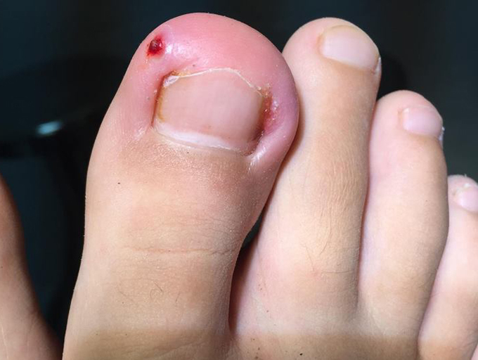 Ngón chân cái bị sưng đau mưng mủ do đâu? Cần làm gì? - Ảnh 2. Ngón chân cái bị sưng đau mưng mủ do đâu? Cần làm gì? - Ảnh 2.