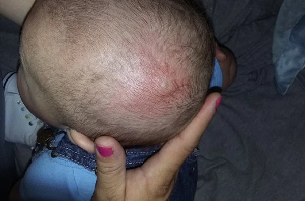 Bé bị nổi cục u mềm trên đầu do đâu? Đây là dấu hiệu cảnh báo bệnh lý nào ở trẻ? - Ảnh 3.