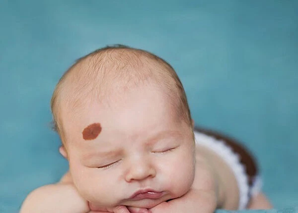Bé bị nổi cục u mềm trên đầu do đâu? Đây là dấu hiệu cảnh báo bệnh lý nào ở trẻ? - Ảnh 6.