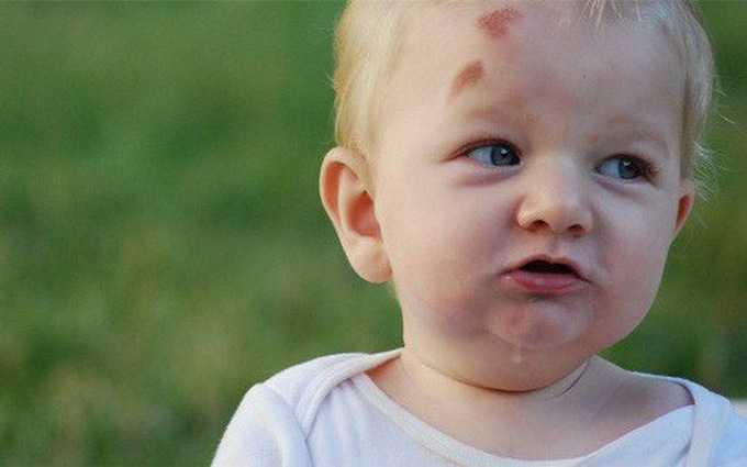 Bé bị nổi cục u mềm trên đầu do đâu? Đây là dấu hiệu cảnh báo bệnh lý nào ở trẻ? - Ảnh 5.