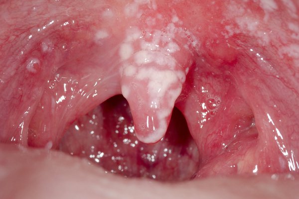 Đốm đỏ trên vòm miệng là do đâu? Nguyên nhân và cách điều trị - Ảnh 4.