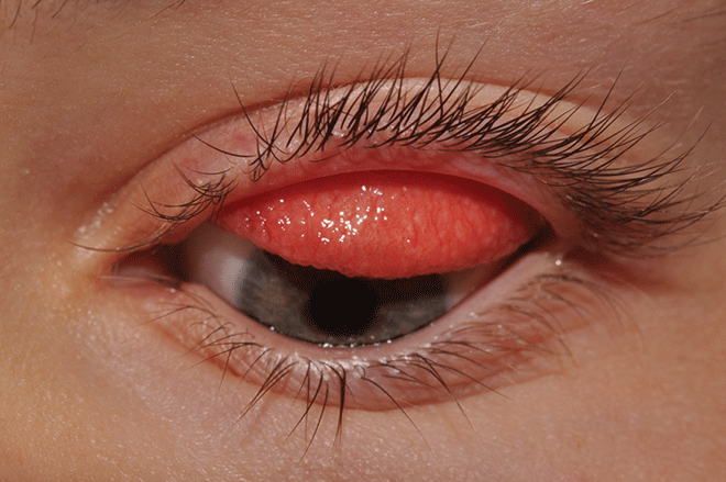 Các loại dị ứng mắt và triệu chứng để phân biệt chính xác nhất - Ảnh 5.