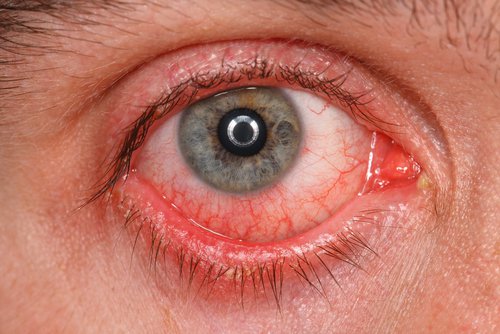 Các loại dị ứng mắt và triệu chứng để phân biệt chính xác nhất - Ảnh 4.