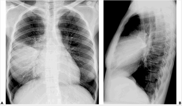 Viêm phổi do mycoplasma: Dấu hiệu, nguyên nhân và cách điều trị - Ảnh 3.