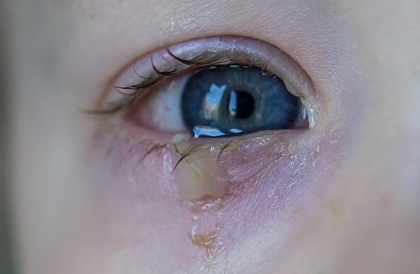 Đau mắt đỏ ở trẻ nhỏ gia tăng: Khi nào cần thăm khám bác sĩ? - Ảnh 2.