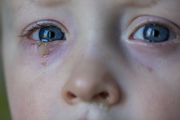 Đau mắt đỏ ở trẻ nhỏ gia tăng: Khi nào cần thăm khám bác sĩ? - Ảnh 3.