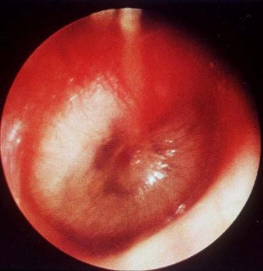 Viêm tai giữa tái phát ở trẻ: nguyên nhân và hướng dẫn dùng thuốc - Ảnh 4.