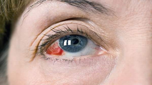 Đột quỵ mắt là gì? Dấu hiệu, nguyên nhân và cách phòng ngừa - Ảnh 2.