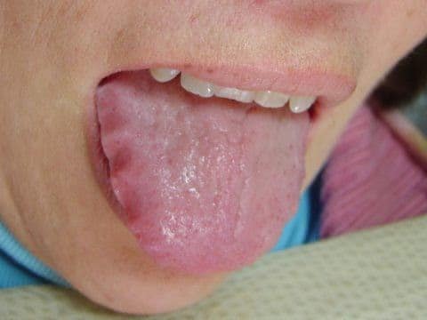 Lưỡi vỏ sò là gì? Lưỡi vỏ sò cảnh báo gì về tình trạng sức khỏe của bạn - Ảnh 5.