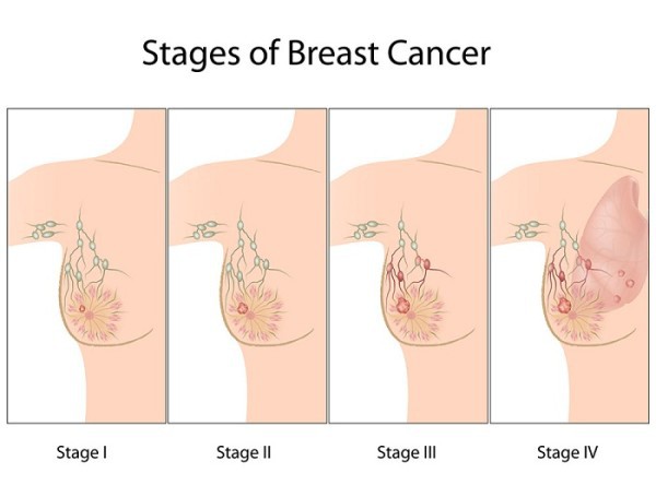 Ung thư vú: dấu hiệu, nguyên nhân và cách điều trị chi tiết - Ảnh 6.