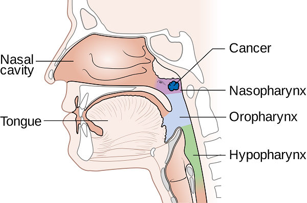 Ung thư vòm họng giai đoạn 2: Dấu hiệu, cách điều trị và tiên lượng sống - Ảnh 2.