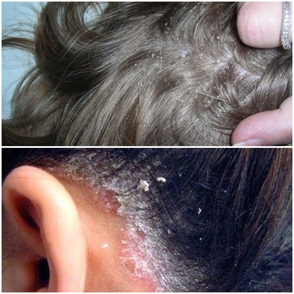 5 bí kíp trị nấm da đầu hiệu quả từ thiên nhiên - Ảnh 1.