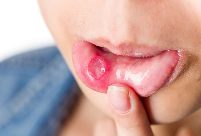Ung thư miệng giai đoạn cuối có những triệu chứng nào? - Ảnh 3.