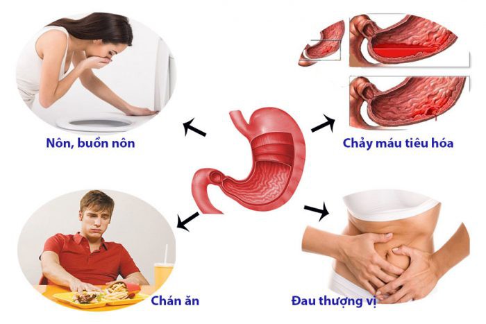 Một số loại thuốc gây đau dạ dày mà bạn cần biết - Ảnh 1.