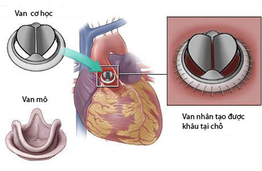 Những nguyên tắc cơ bản trong việc chăm sóc bệnh nhân thay van tim cơ học - Ảnh 1.