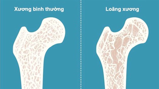 Tại sao xương người già giòn và dễ gãy? Biện pháp cải thiện mật độ xương hiệu quả cho người cao tuổi - Ảnh 3.