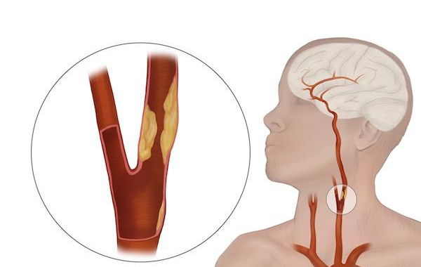 Hẹp động mạch cảnh: Nguyên nhân hàng đầu gây tai biến mạch máu não - Ảnh 1.