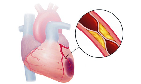 Lão hóa hệ tim mạch: nguy cơ chết người người cao tuổi nào cũng cần biết - Ảnh 1.