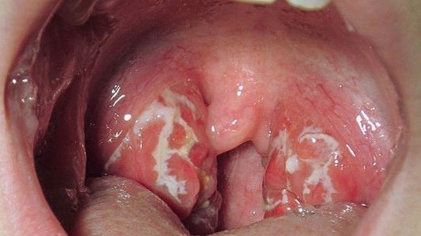 Bệnh lậu ở nam giới là gì?