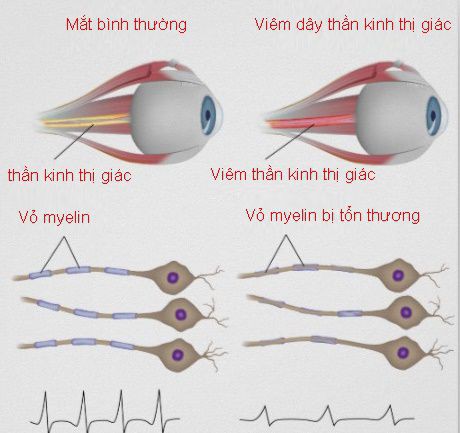  Viêm dây thần kinh thị giác là gì? - Ảnh 1.