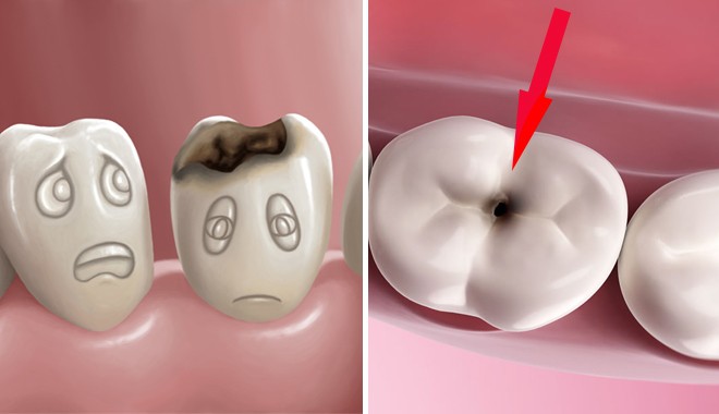 10 Dấu hiệu sâu răng dễ nhận biết và cách điều trị dứt điểm - Ảnh 2.